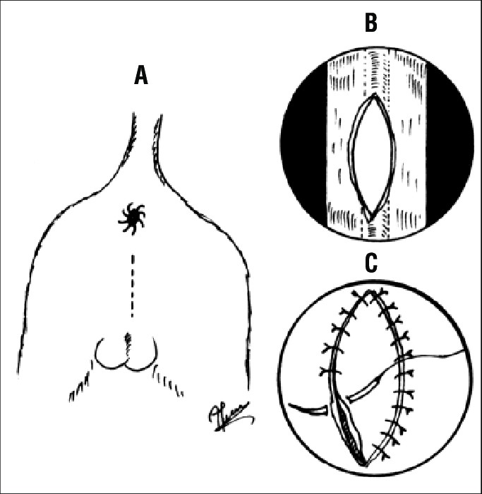 Male cat outlet urethra surgery