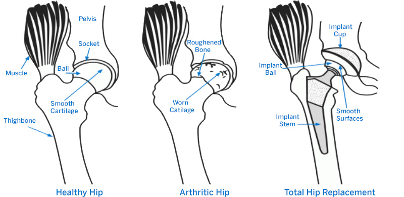 Total Hip Replacement Thr Cemented And Cementless Southwest